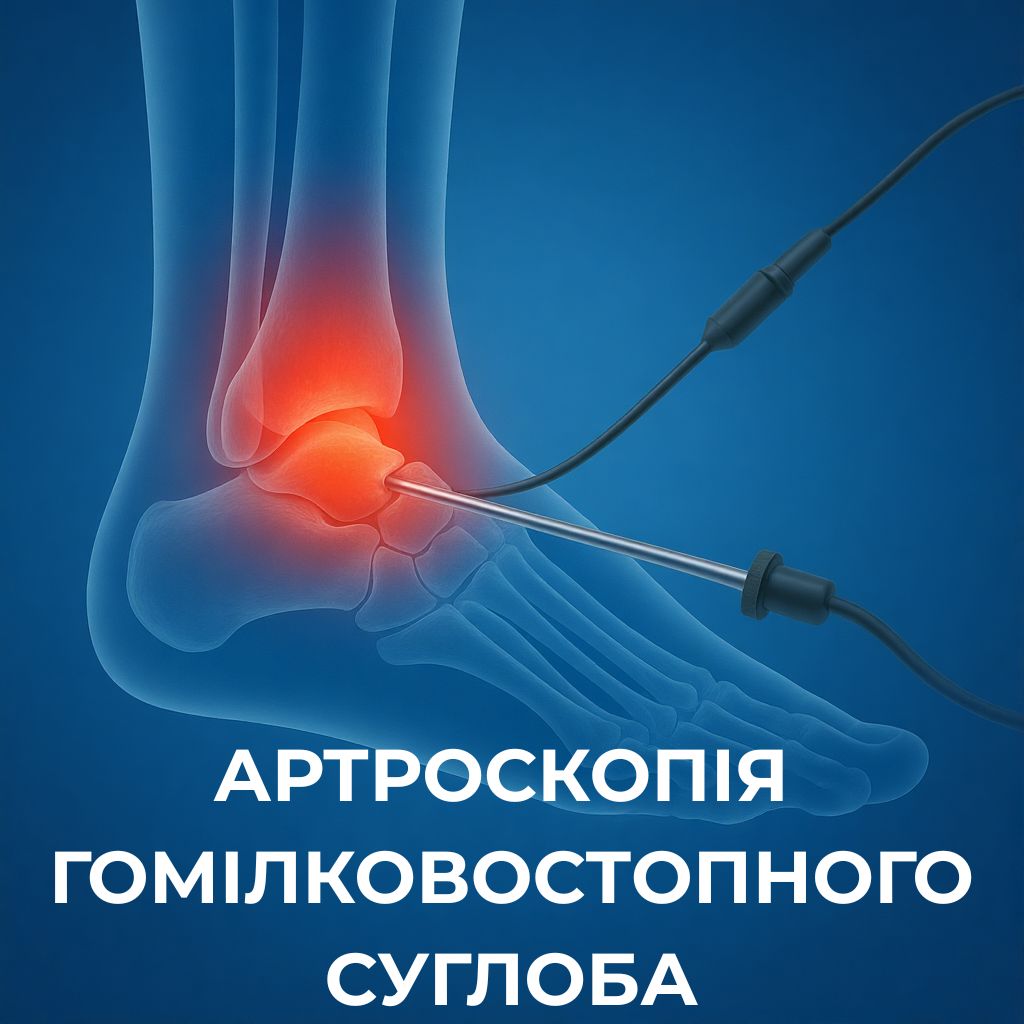 Артроскопія гомілковостопного суглоба у Волинському центрі ортопедії