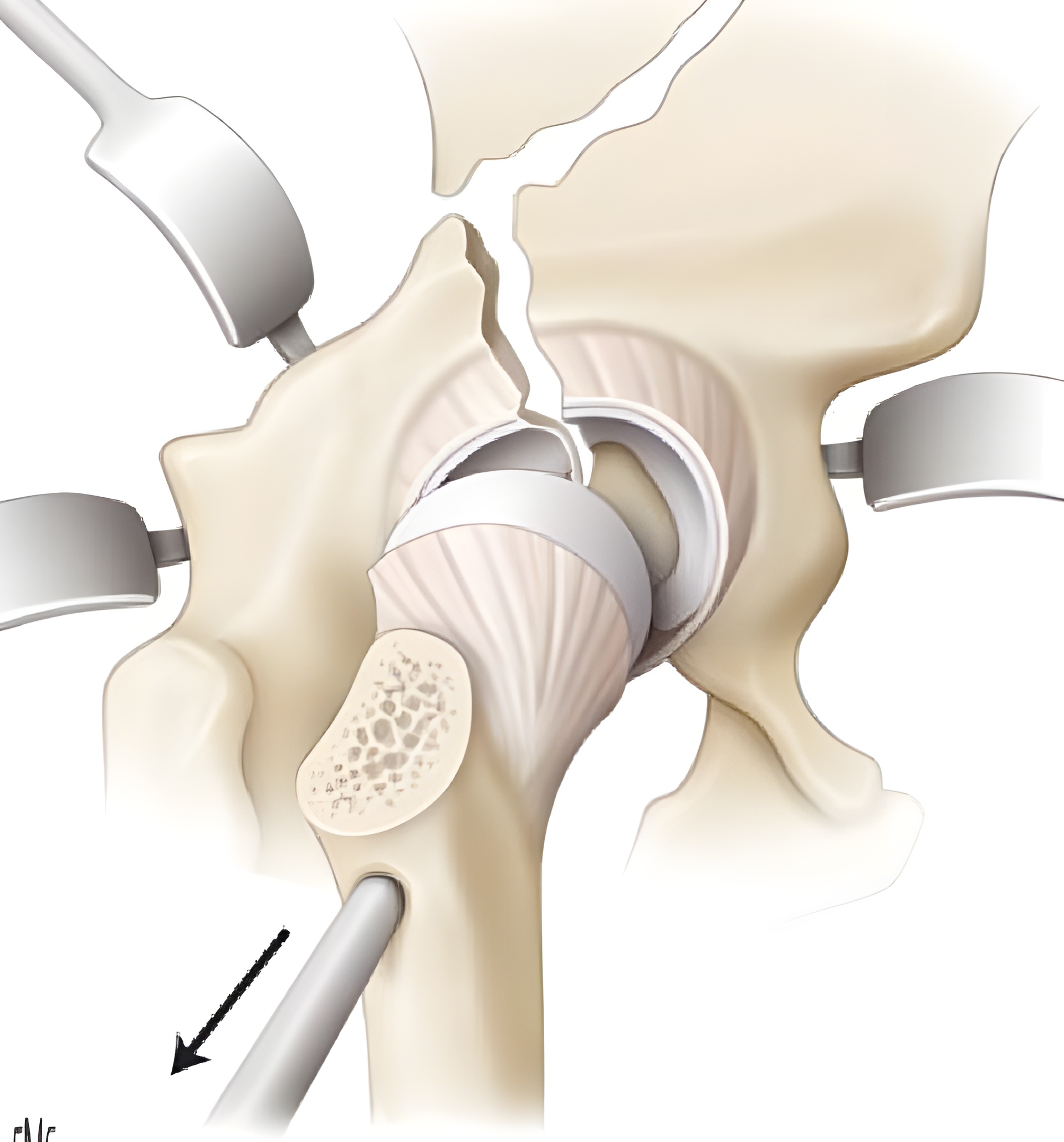 Перелом кульшової западини