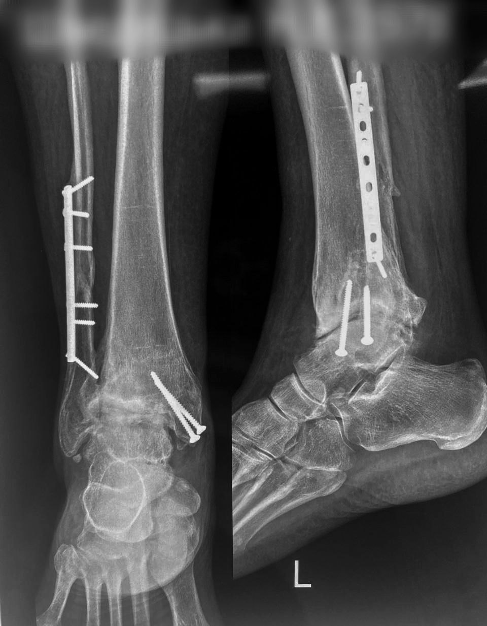 Внутрішня фіксація пластинами та гвинтами: приклад