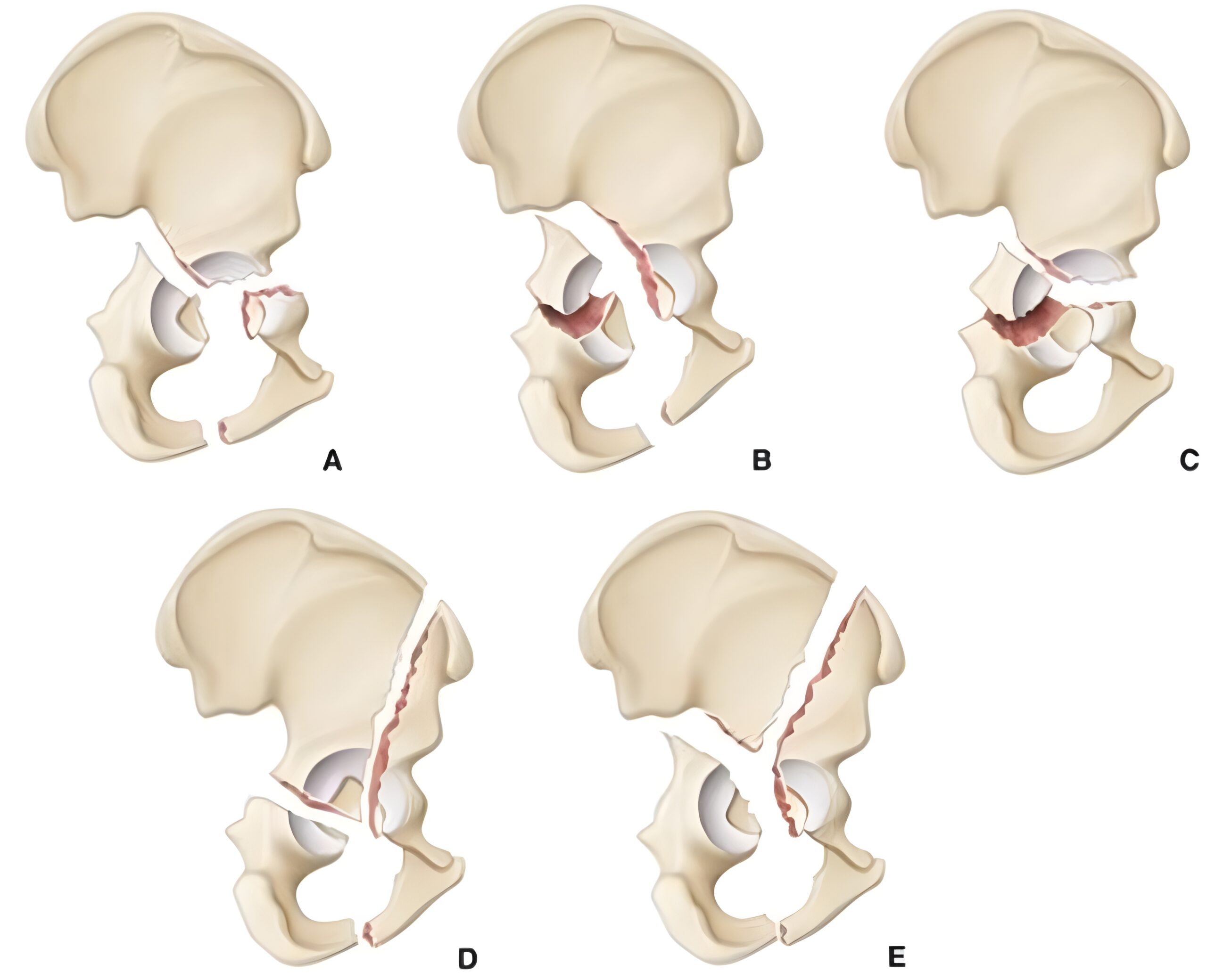 Типи переломів кульшової западини