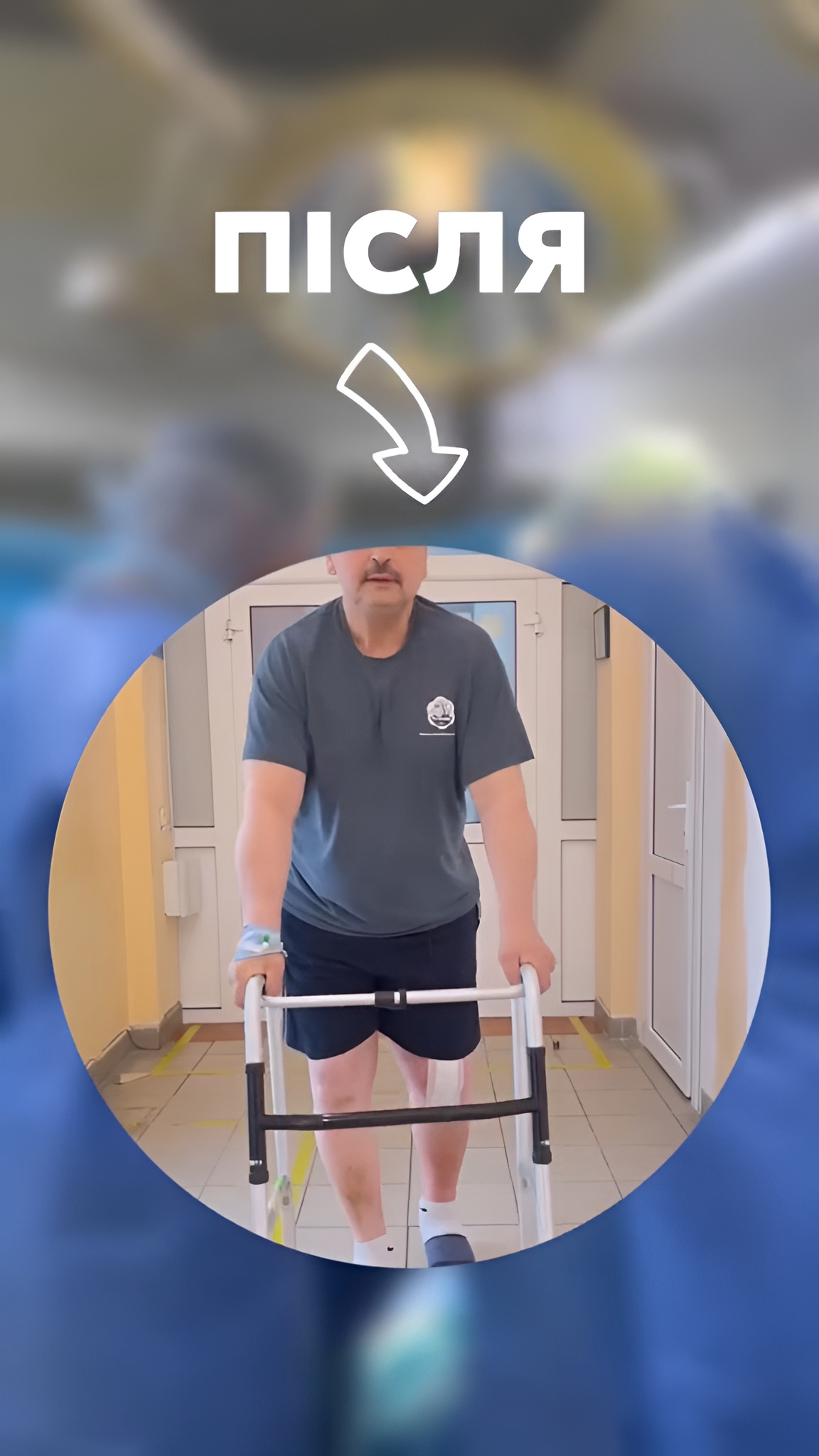 Ендопротезування колінного суглоба